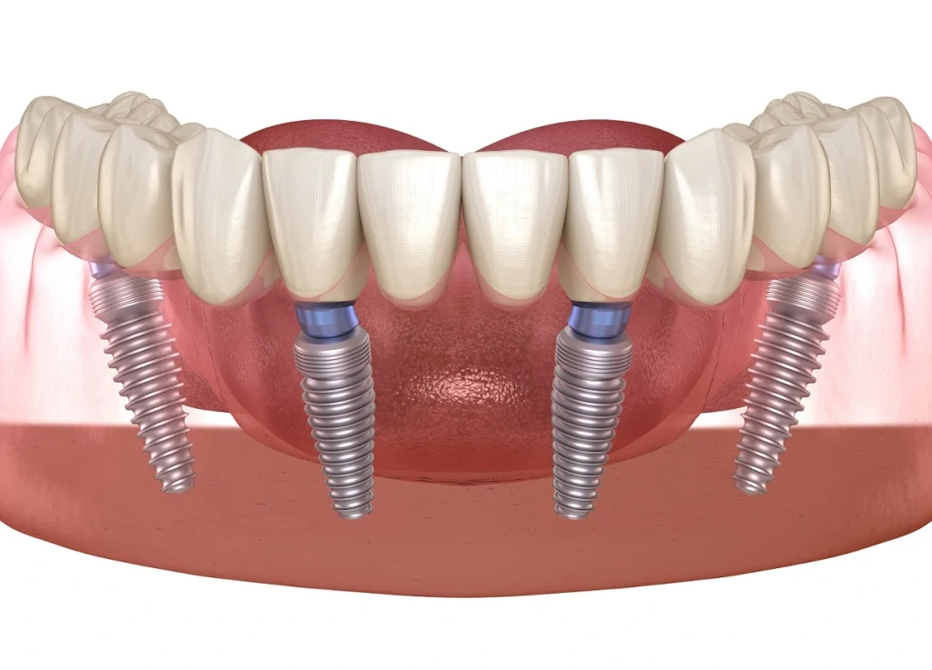 How much dental implants cost