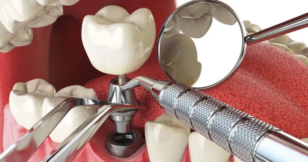 How much dental implants cost