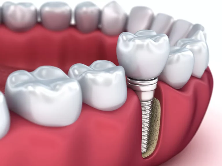 How much dental implants cost