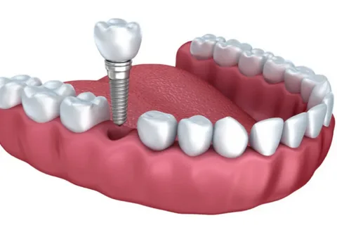 How much dental implants cost