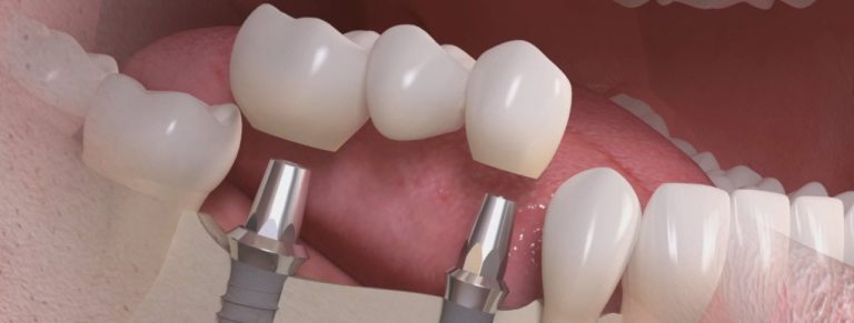 Types of Dental Implant Surgery
