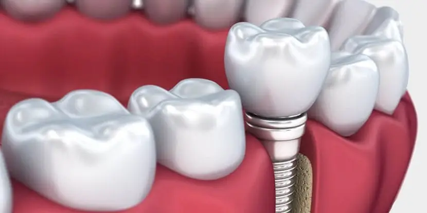 كل ماتحتاج معرفتة عن كيفية زراعة الاسنان بالليزر كيفية زراعة الاسنان بالليزر