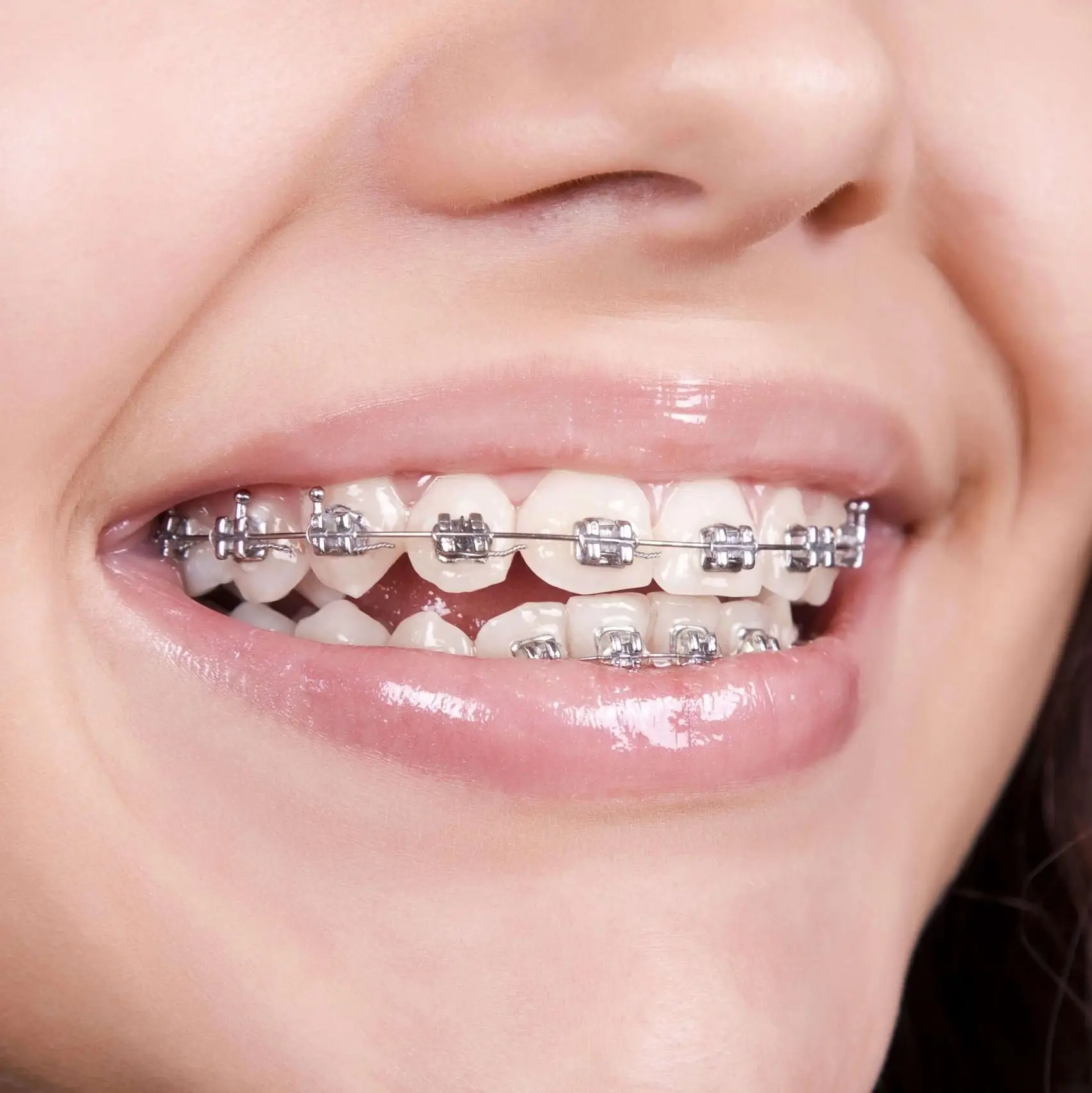 هل تقويم الأسنان يؤلم؟ اهم النصائح لتخفيف الم تقويم الاسنان هل تقويم الأسنان يؤلم