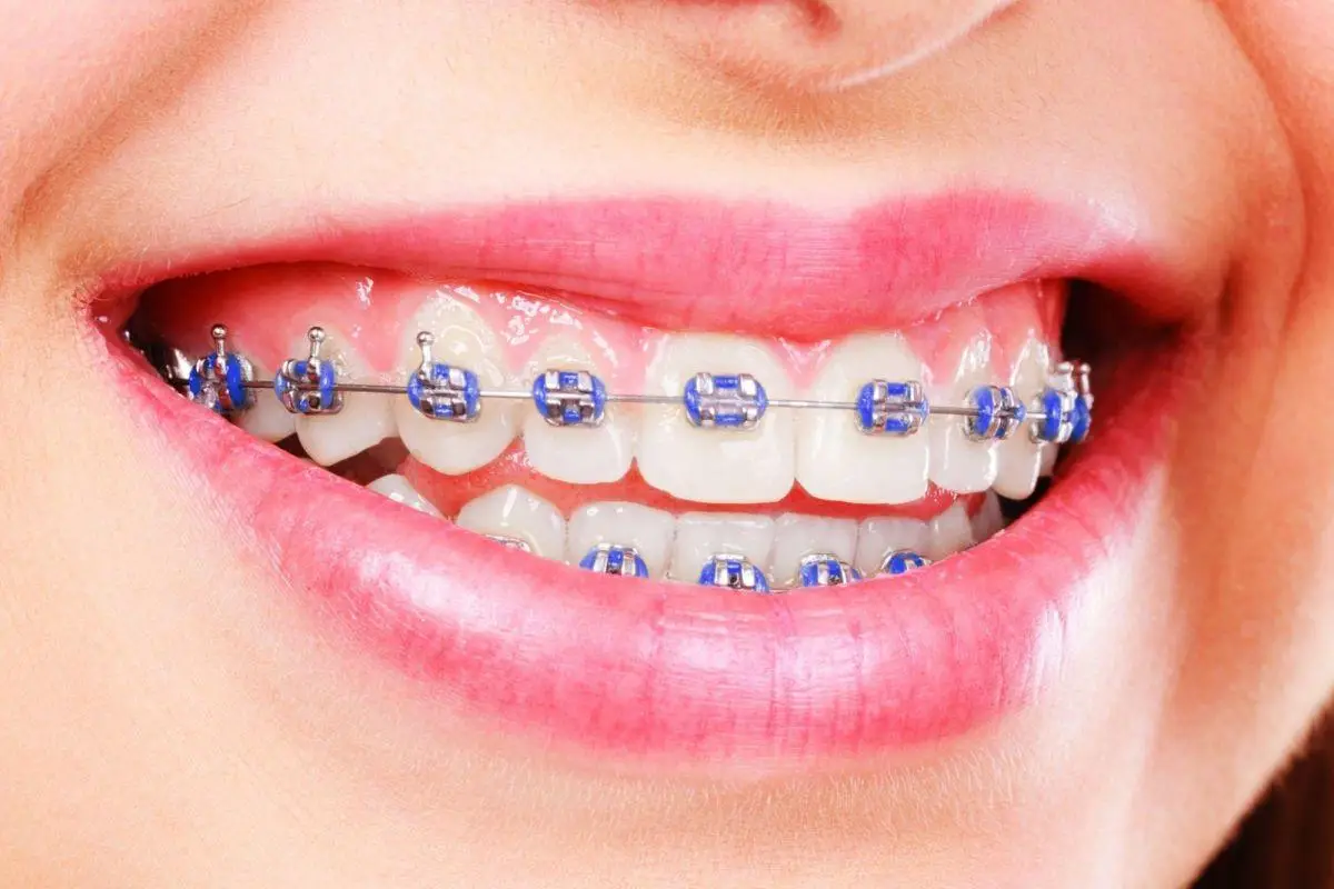 متى تتعدل الأسنان بعد التقويم