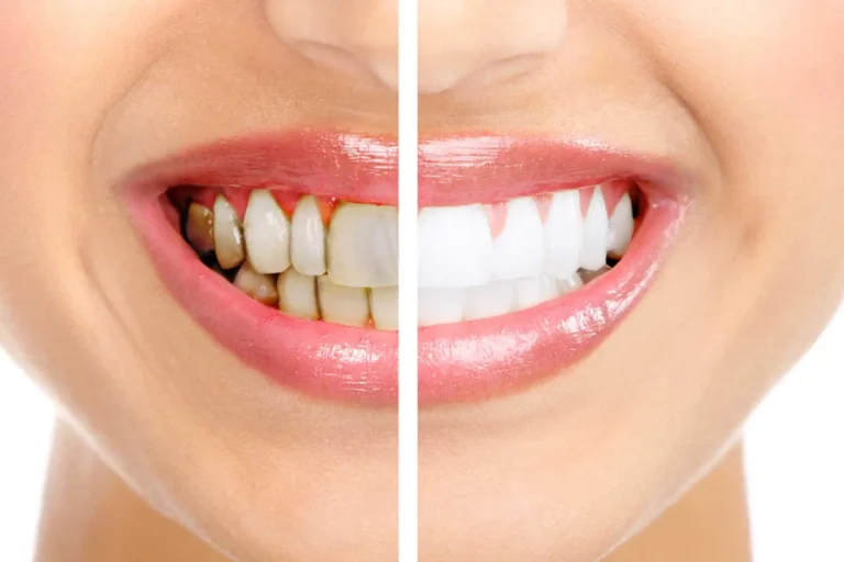 كيف اعرف ان التسوس وصل للعصب