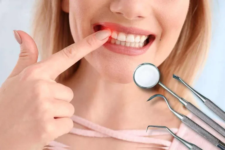 اسباب التهاب الضرس بعد سحب العصب