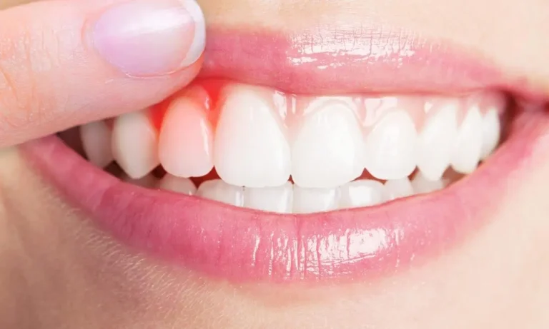 الفرق بين التهاب اللثة والتهاب العصب