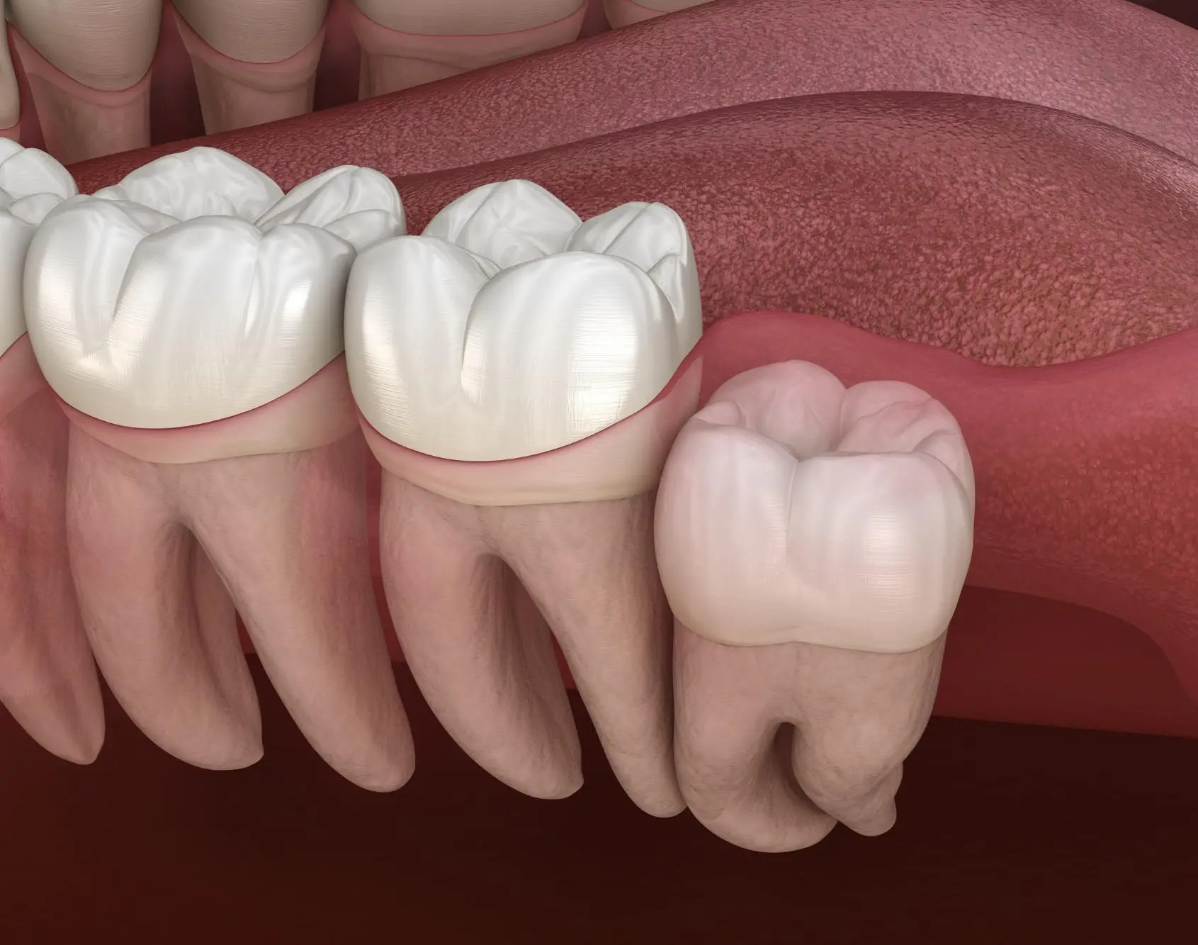 علاج ضرس العقل بدون خلع علاج ضرس العقل بدون خلع