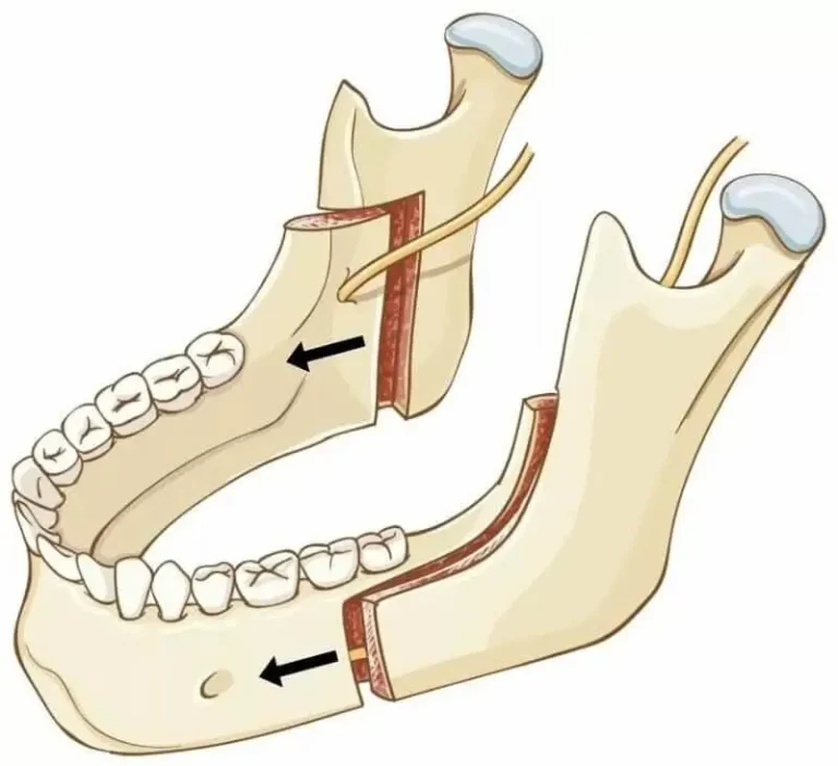 جراحة الفك السفلي المتراجع