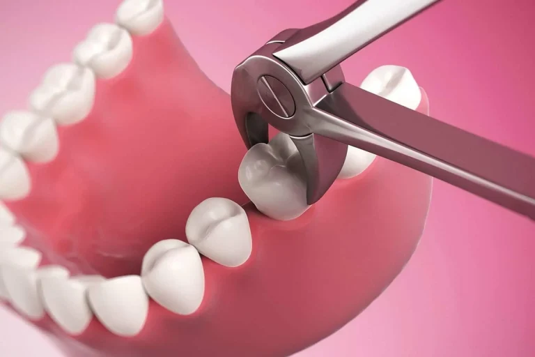 خراج تحت الضرس بعد سحب العصب