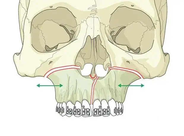 جراحة الفك العلوي قبل وبعد