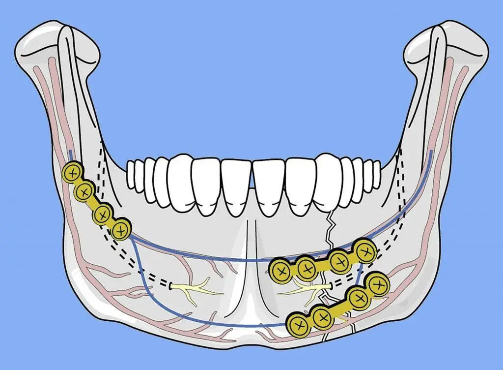 جراحة الفك السفلي المتقدم