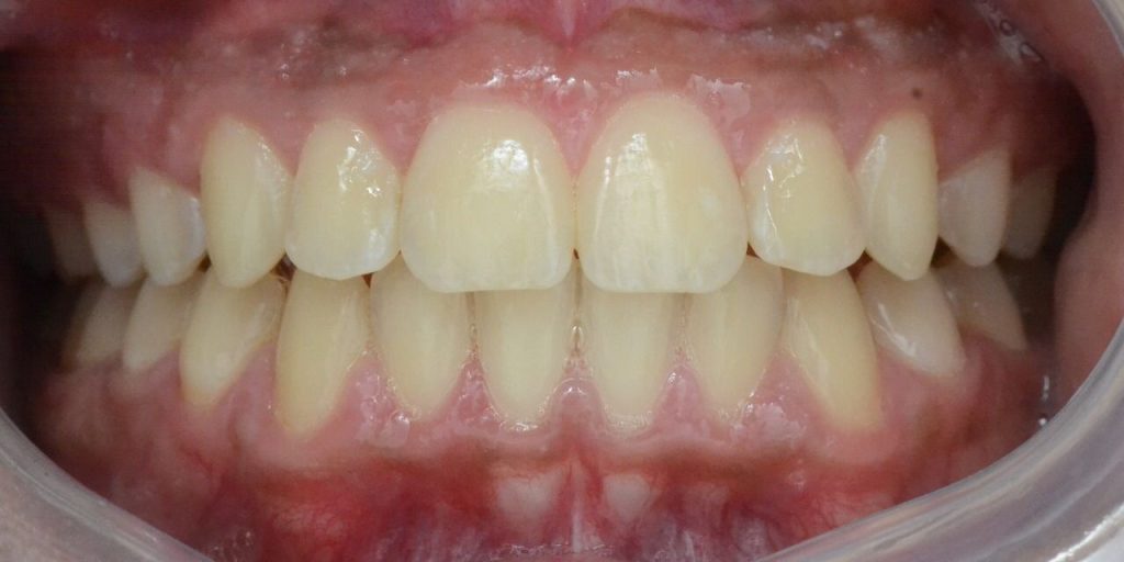 صوره ل ما بعد تقويم الشفاف