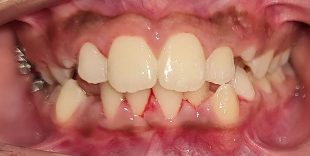 تقويم الأسنان الشفاف - قبل 