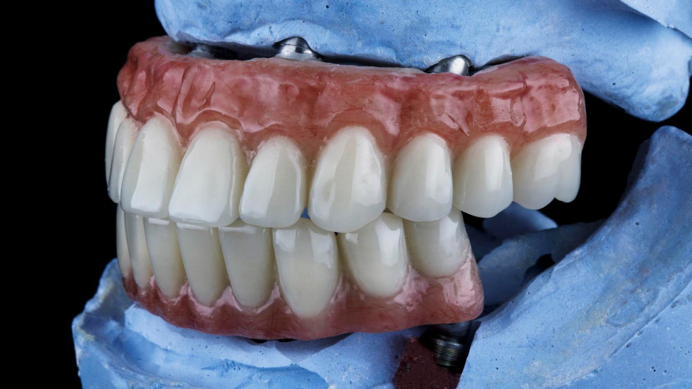 زراعة الأسنان All-on-4 في جدة – وش تتوقع؟ all on 4