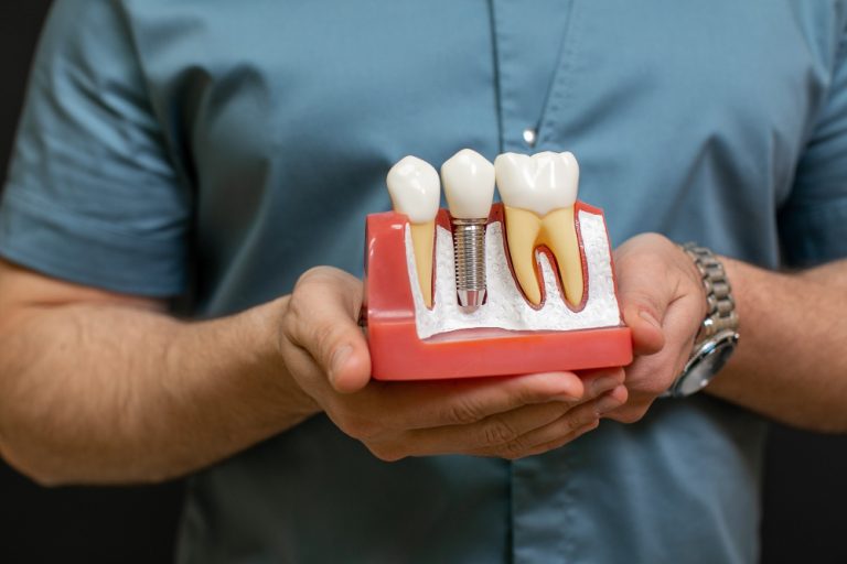 Tooth Replacement in Jeddah: A Friendly Guide for Expat Smiles
