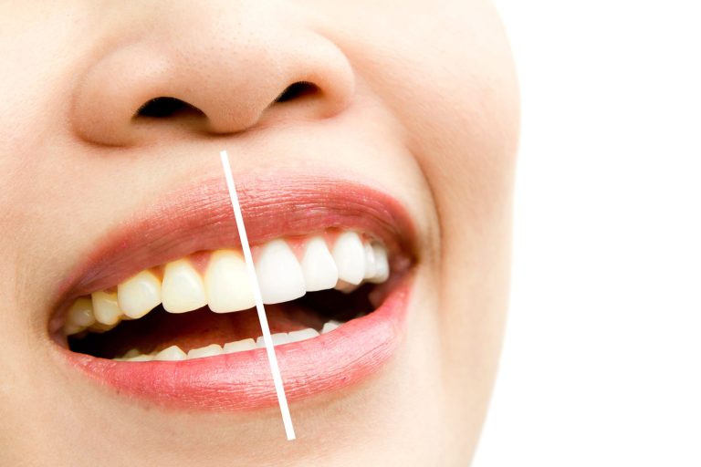 Teeth Whitening in Jeddah: Your Guide to a Brighter, More Confident Smile