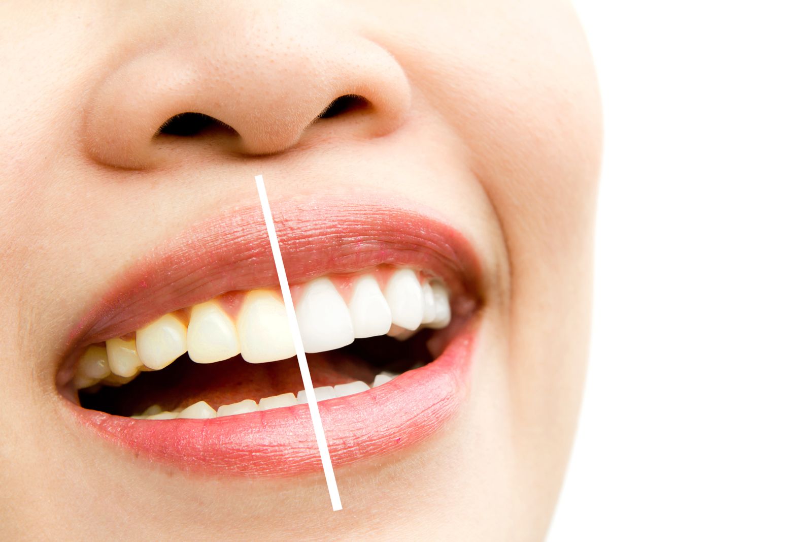 Teeth Whitening in Jeddah: Your Guide to a Brighter, More Confident Smile Teeth Whitening in Jeddah: Your Guide to a Brighter, More Confident Smile
