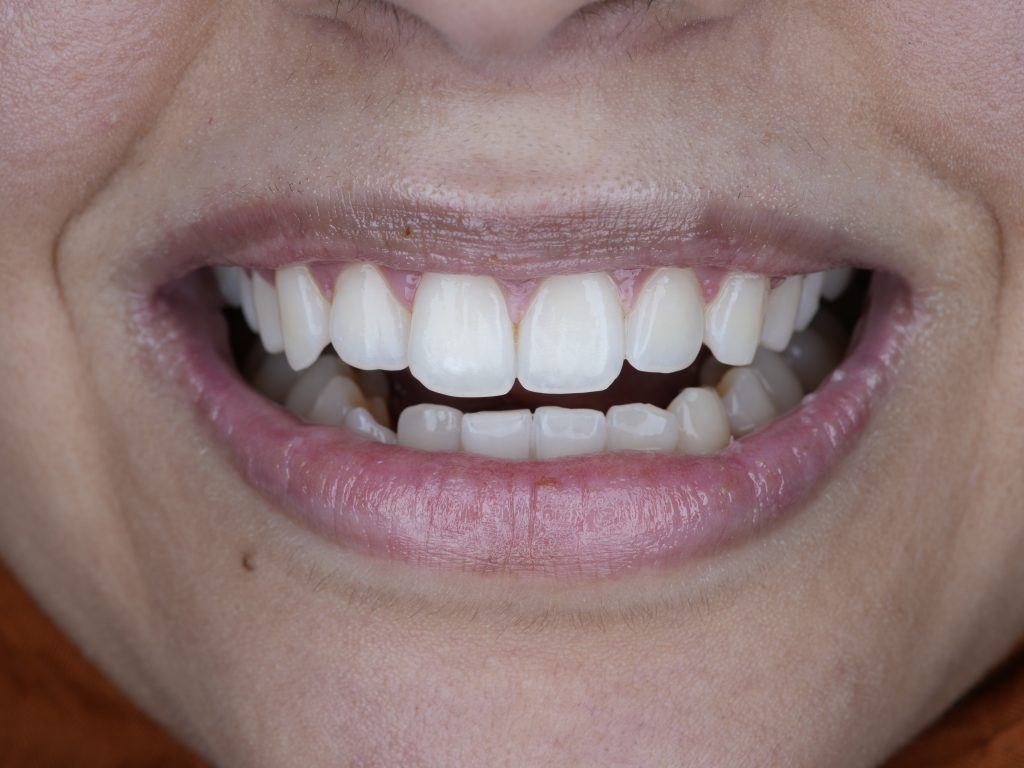Teeth Whitening in Jeddah: Your Guide to a Brighter, More Confident Smile