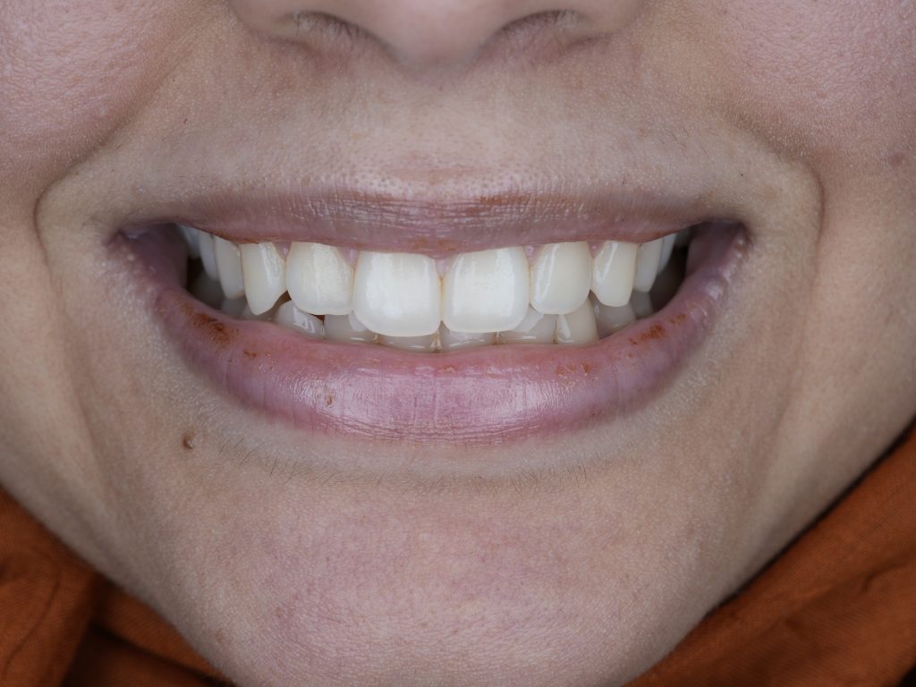 Teeth Whitening in Jeddah: Your Guide to a Brighter, More Confident Smile