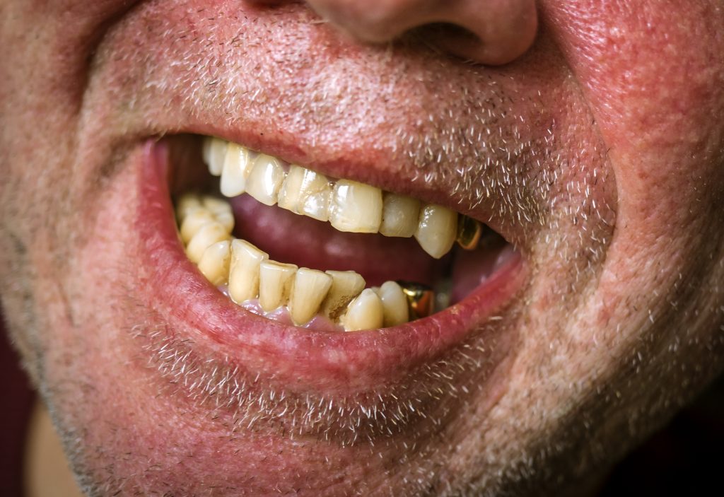 تزاحم الأسنان — لماذا يحدث وكيف نعالجه؟