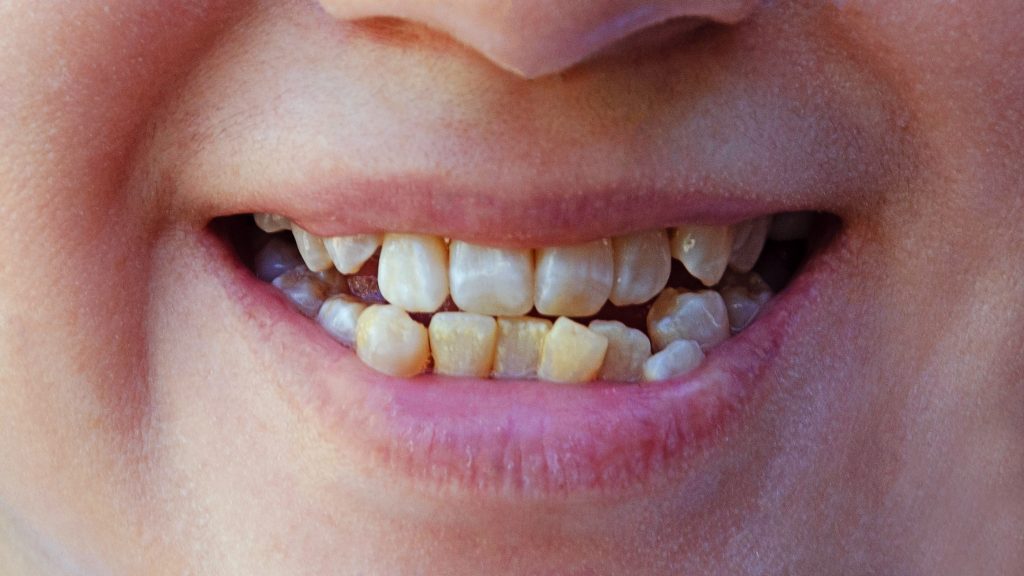 تزاحم الأسنان — لماذا يحدث وكيف نعالجه؟