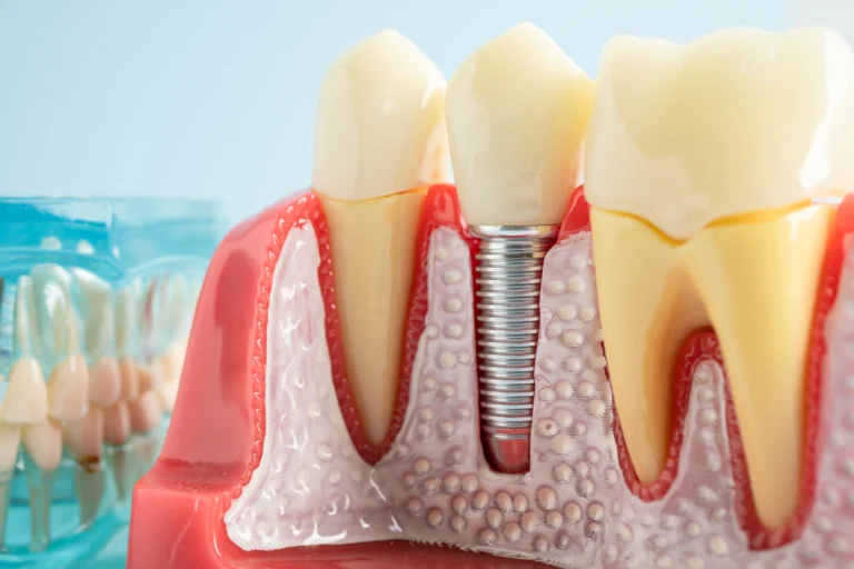 All-on-Six Implant: A Complete Guide to Full-Arch Tooth Replacement in Jeddah