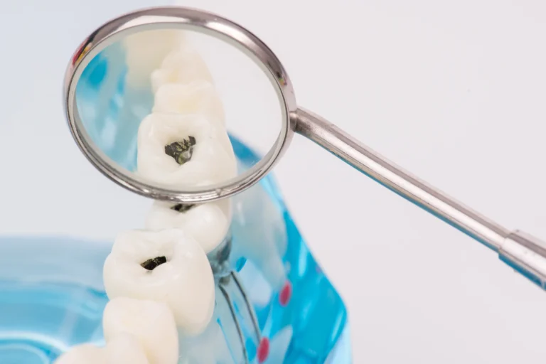 Amalgam Filling: What You Need to Know About Silver Dental Restorations in Jeddah