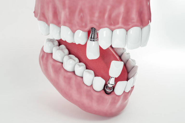 Types of Dental Implants: Choosing the Right Implant Solution for a Healthy, Confident Smile in Jeddah