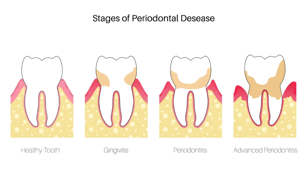Can You Get Veneers or Implants with Gum Disease? The Expert Guide for Jeddah Expats