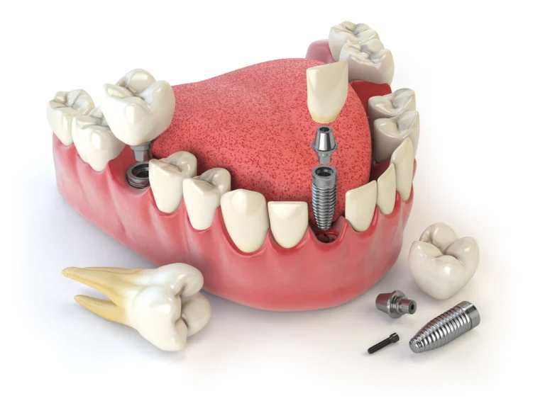 Immediate vs. Delayed Implant Placement: Which Is Best for You?