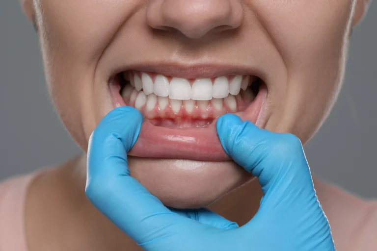 Can You Get Veneers or Implants with Gum Disease? The Expert Guide for Jeddah Expats