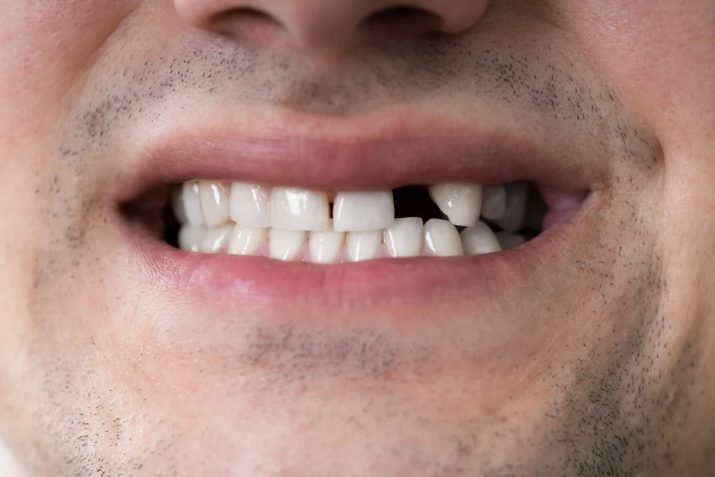 Tooth Only One One Tooth Missing Treatment in Jeddah - Tam Dental
