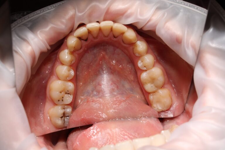 How to Fix Decay Tooth: Complete Guide to Tooth Decay Treatment in Jeddah