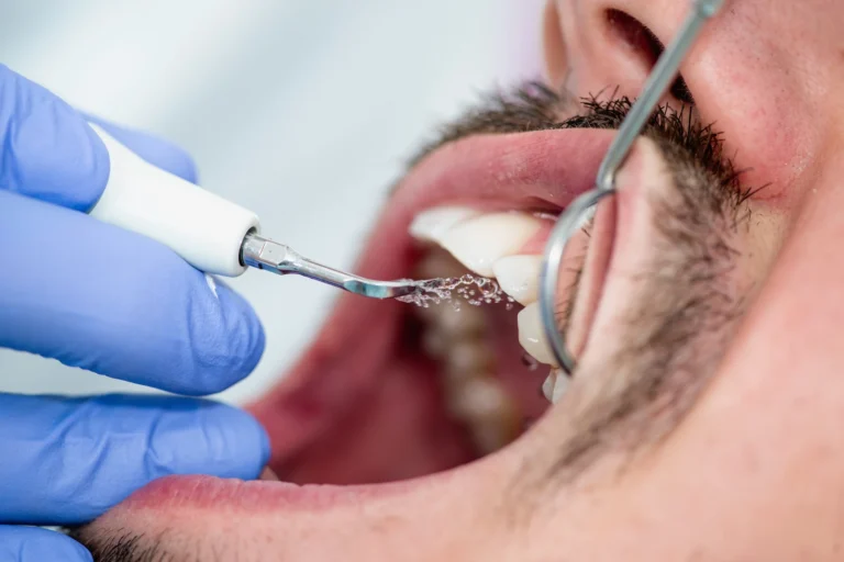 Deep Cleaning Teeth: A Complete Guide for Residents and Expats in Jeddah