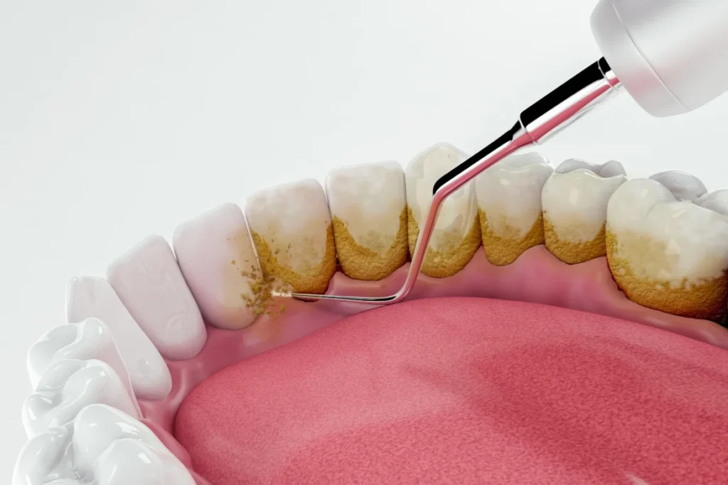 Cleaning Teeth Tartar: The Complete Guide for Residents in Jeddah