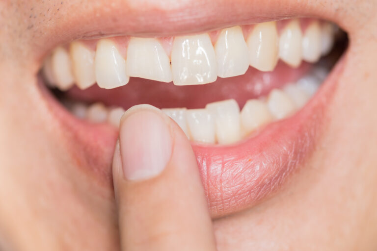 How to Fix a Chipped Front Tooth: Your Complete Guide for a Confident Smile in Jeddah