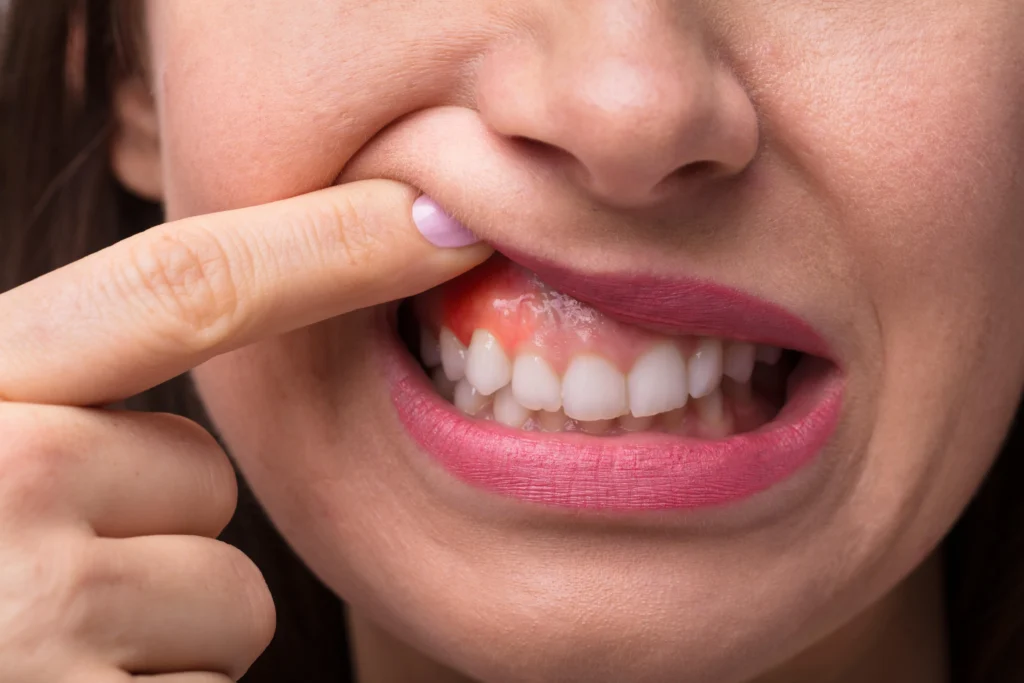 Woman showing swollen, red gums indicating tooth sensitivity or gum inflammation