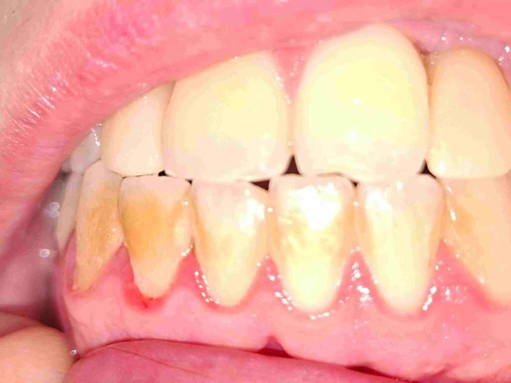 أنواع التهاب اللثة بالصور: كيف تميّزها وأسبابها وطرق علاجها؟ صورة سريرية توضح التهاب اللثة والجير