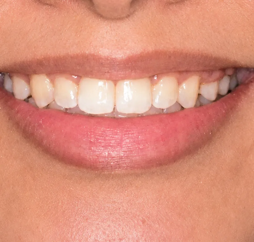 Invisalign and Invisible Braces in Jeddah: Your No-Stress Guide to Straighter Teeth - Tam Dental After applying Invisalign to the patient