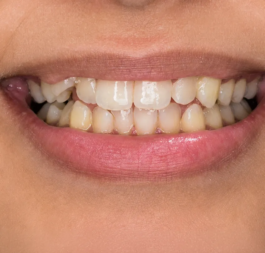 Invisalign and Invisible Braces in Jeddah: Your No-Stress Guide to Straighter Teeth - Tam Dental Before applying Invisalign to the patient