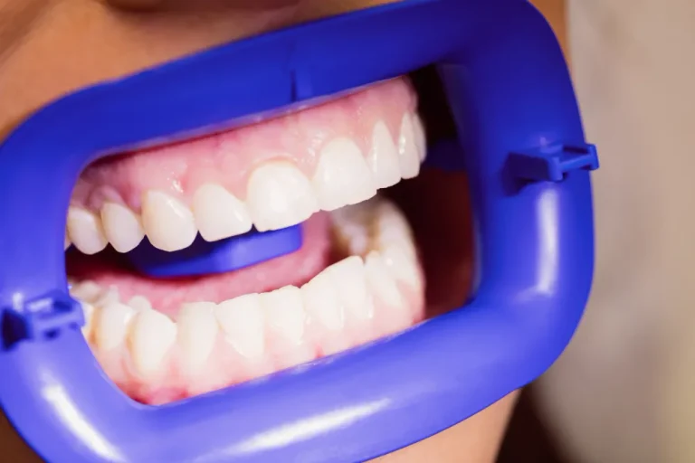 Gummy smile with excess gum showing above the upper teeth.